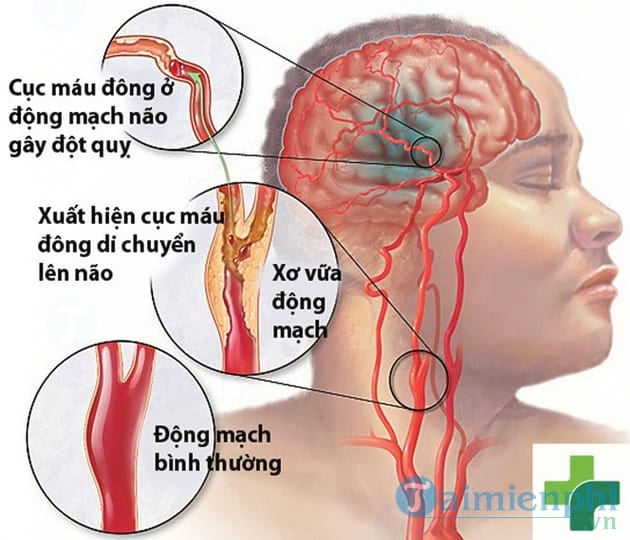 Tai biến mạch máu não